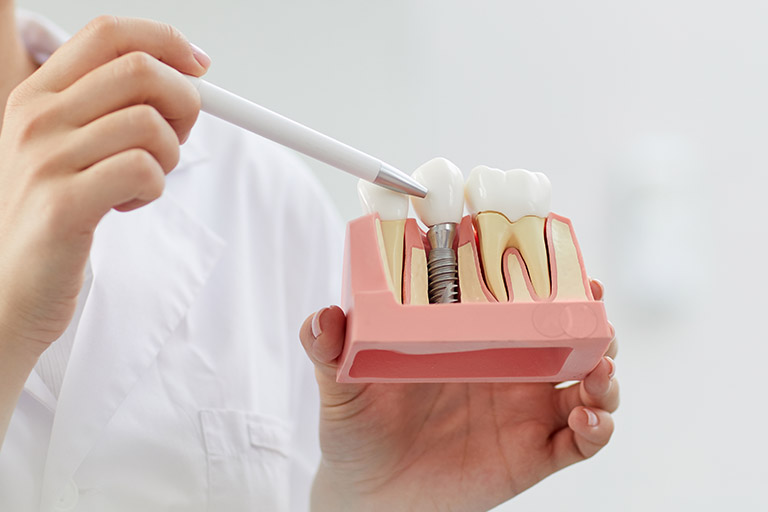 Los implantes dentales son la manera más efectiva de restauración de dientes perdidos