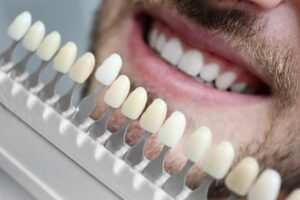 Clinica dental Naves. Las carillas dentales de porcelana tienen ventajas frente a las de composite
