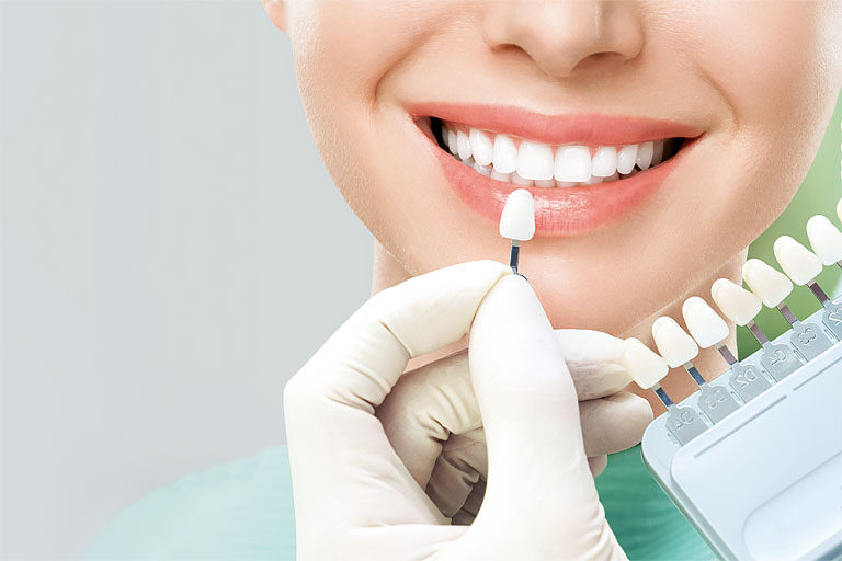 te explicamos como tener los dientes blancos en nuestr aclínica dental, especializada en carillas dentales en Oviedo