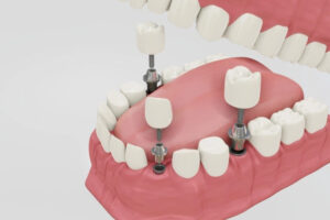 Clínica Dental Naves. Implantes dentales ofreciendo seguridad frente a los puentes dentales