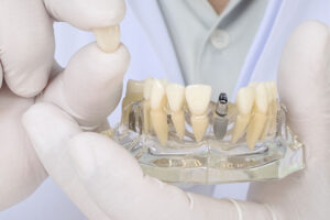 Clínica Dental Naves. Desmintiendo mitos sobre implantes dentales