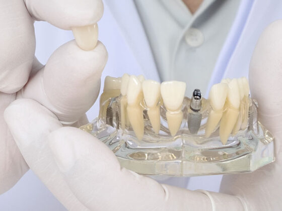 Clínica Dental Naves. Desmintiendo mitos sobre implantes dentales