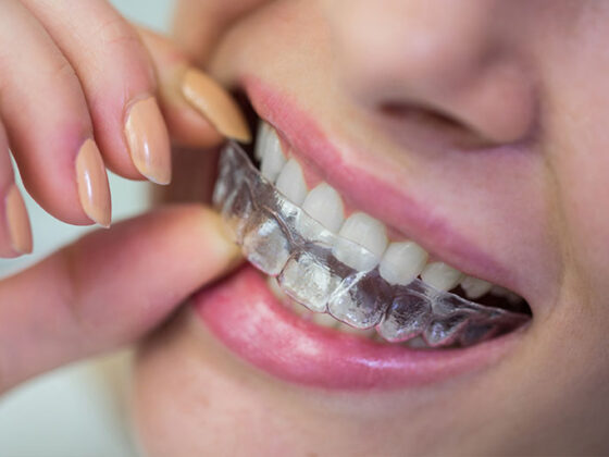 Clínica Dental Naves. Invisalign ayuda a tener los dientes alineados.