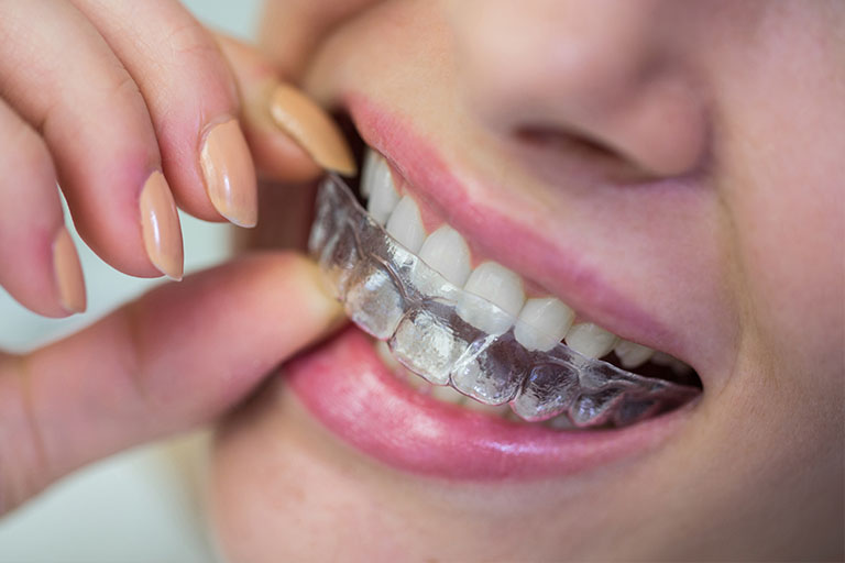 Clínica Dental Naves. Invisalign ayuda a tener los dientes alineados.