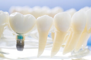 Clínica Dental Naves. Muestra de implantes dentales sanos, sin rechazo.