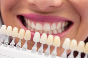 Sensibilidad dental solucionada con carillas dentales en la Clínica Dental Naves