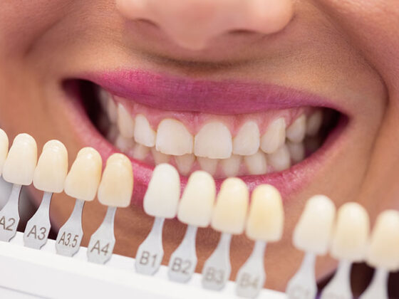 Sensibilidad dental solucionada con carillas dentales en la Clínica Dental Naves
