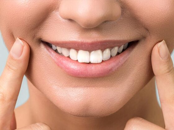 Clínica Dental Naves. Las carillas dentales son la solución ideal para lucir una buena sonrisa en año nuevo