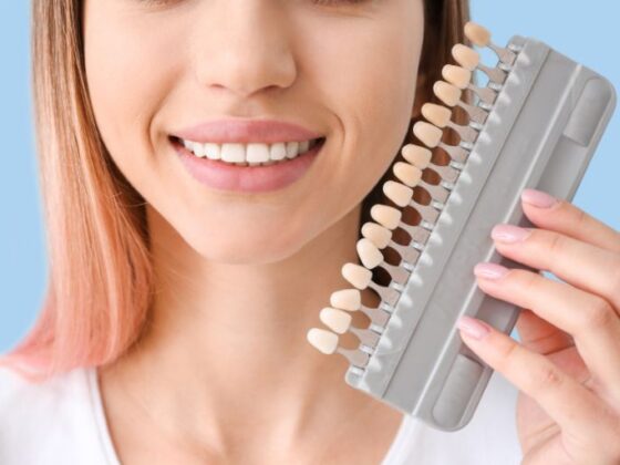 Clínica Dental Naves. Las carillas dentales pueden hacerte ganar mucha autoestima
