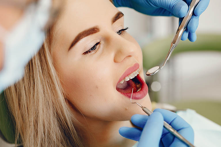 Clínica Dental Naves. Las carillas dentales pueden hacerte ganar mucha autoestima
