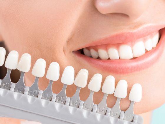 Clínica Dental Naves. Las carillas dentales son una solución perfecta a problemas dentales estéticos leves.