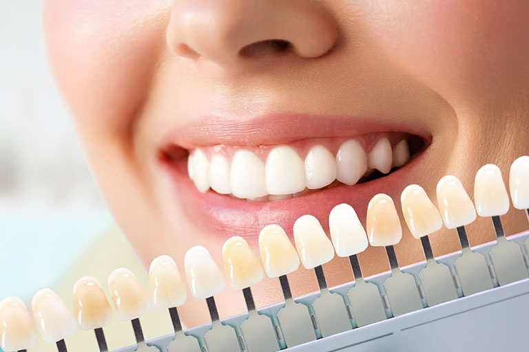 Clínica Dental Naves. Todo lo que necesitas saber sobre las carillas dentales.