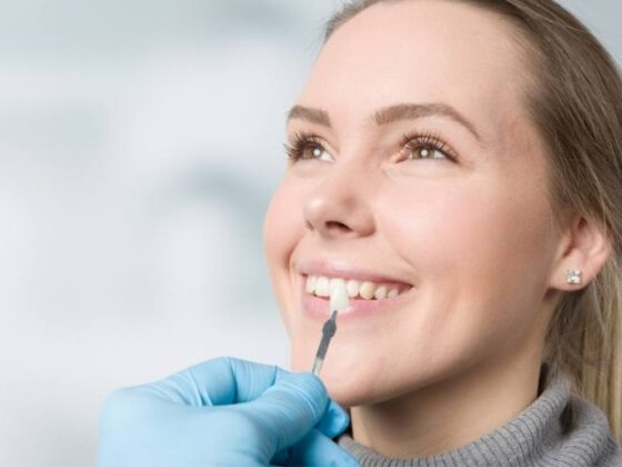 Clínica Dental Naves. ¿Pueden las carillas dañar tus dientes?