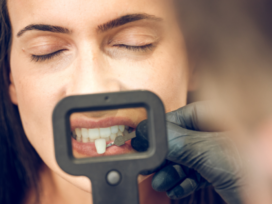 Clínica Dental Naves. ¿Pueden las carillas dañar tus dientes