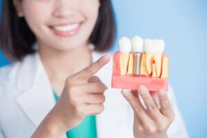 Clínica Dental Naves. 4 mitos sobre los implantes dentales