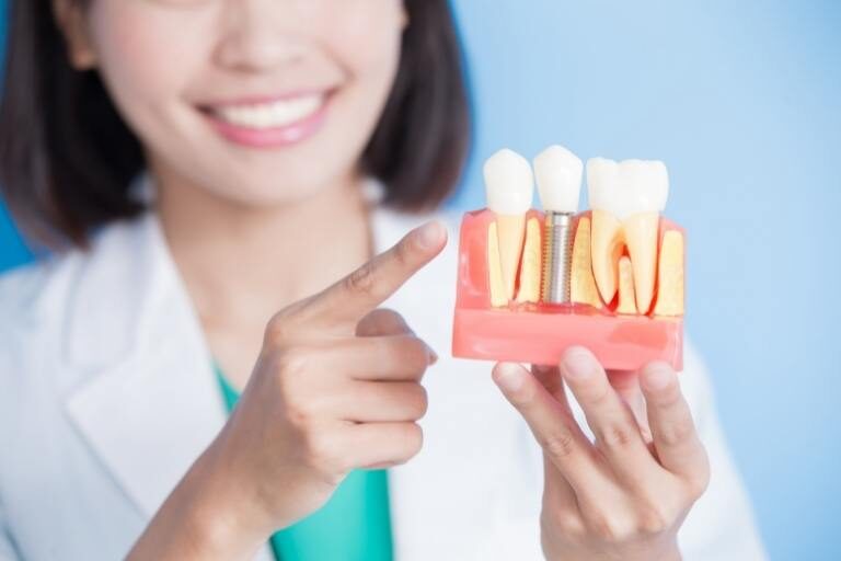 Clínica Dental Naves. 4 mitos sobre los implantes dentales