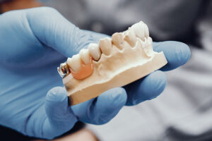 Clínica Dental Naves. Puntos a considerar antes de los implantes dentales