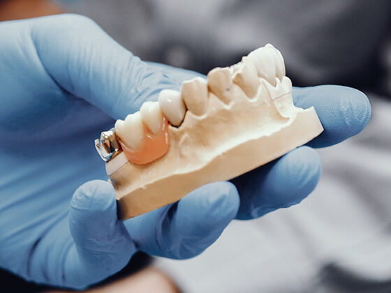 Clínica Dental Naves. Puntos a considerar antes de los implantes dentales