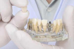 Clínica-Dental-Naves.-Cuidados-de-los-implantes-dentales