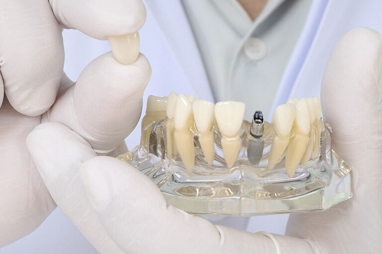 Clínica-Dental-Naves.-Cuidados-de-los-implantes-dentales
