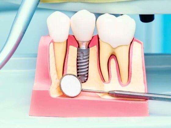 Clínica Dental Naves. 4 facotres que afectan al precio de los implantes dentales