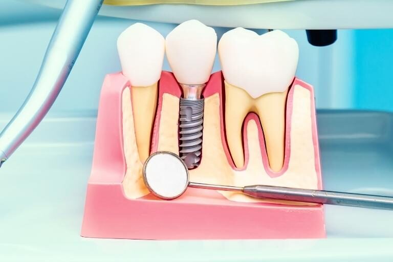 Clínica Dental Naves. 4 facotres que afectan al precio de los implantes dentales