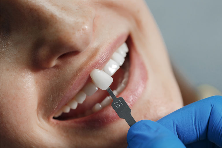 Sustitución del esmalte dental