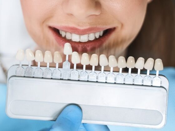 Cuidado de las carillas dentales