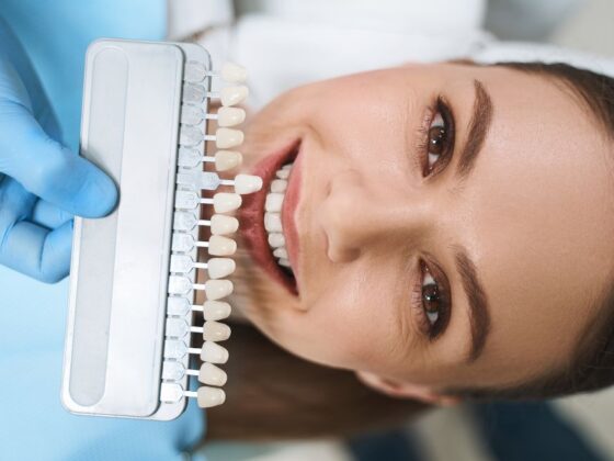 Consejos para cuidar tus carillas dentales