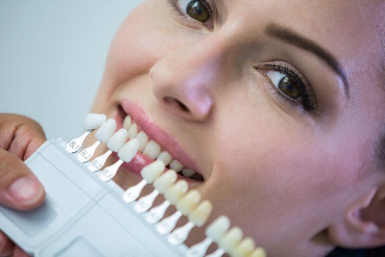 Cómo remodelar mis incisivos laterales cónicos con Carillas - Clínica Dental Naves - Carillas Dentales en Oviedo